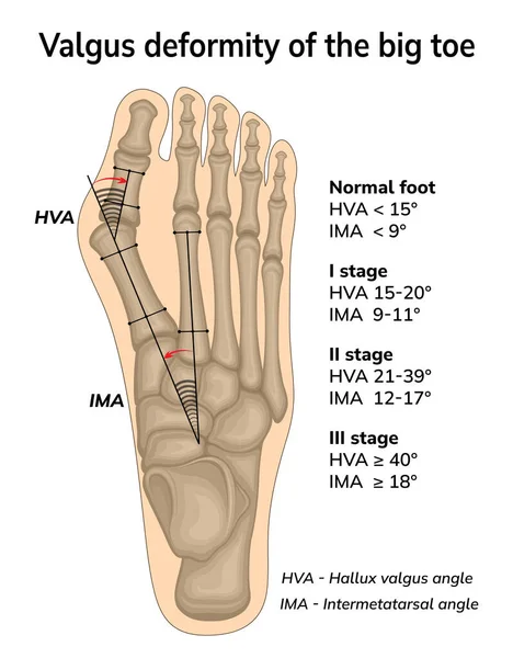 Illustration Valgus Deformity Big Toe Angles Bone Displacement Deformation Shown — Vettoriale Stock