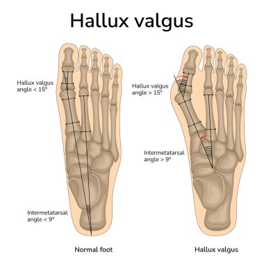 An illustration of the location of the bones in a healthy foot and hallux valgus. The angles of the bones relative to each other are indicated