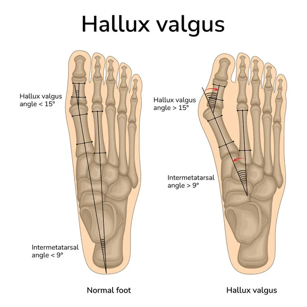 健康な足とハロックスのバルガス中の骨の位置のイラスト 互いに関連する骨の角度が示されています — ストックベクタ