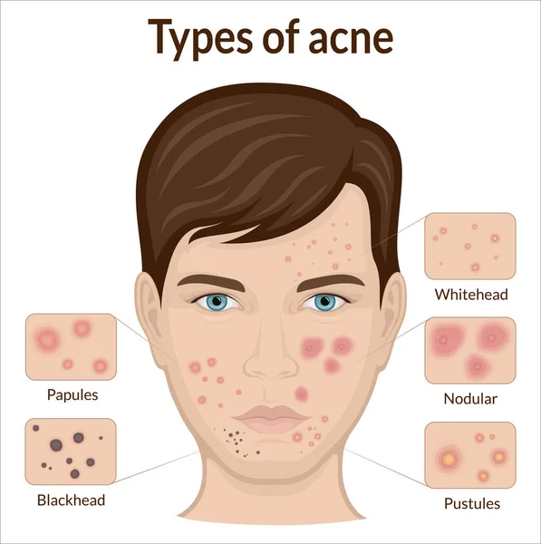Several Types Acne Face Young Man — Vector de stock