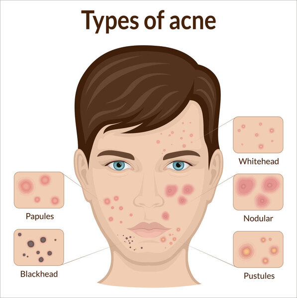 Several types of acne on the face of a young man