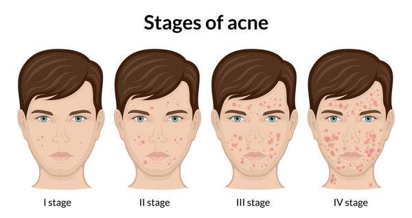 Four stages of acne on the face of a young man