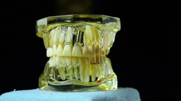 Foto Ravvicinata Dell Odontoiatria Implantare Una Sostituzione Dei Denti Mancanti — Video Stock