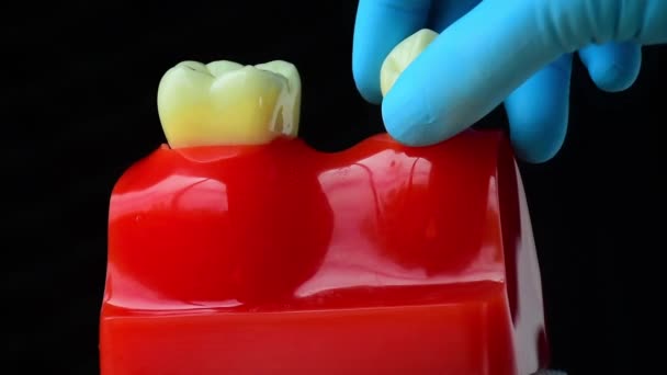Foto Cerca Odontología Del Implante Reemplazo Los Dientes Faltantes Por — Vídeo de stock