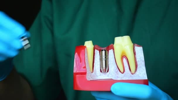 Κοντινή Φωτογραφία Της Οδοντιατρικής Εμφύτευσης Είναι Μια Αντικατάσταση Για Δόντια — Αρχείο Βίντεο