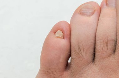 Mantardan etkilenen ayaktaki küçük parmağın tırnağı zarar görmüş.