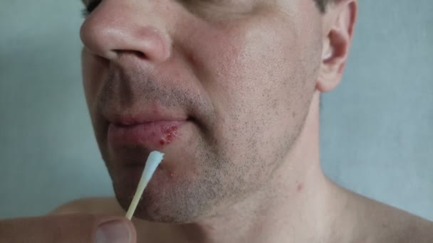 Hombre Aplicando Ungüento Herpes Los Labios Para Tratamiento — Vídeo de stock