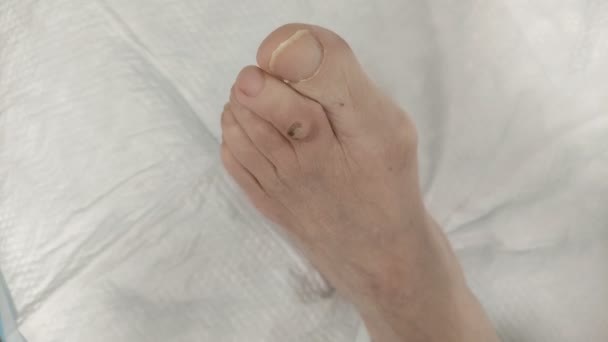 Doktor Yaşlı Bir Hastanın Bacağındaki Iltihaplı Yarayı Iyileştirici Merhemle Tedavi — Stok video