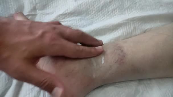 Лікар Травматолог Лікує Синці Пошкодженій Нозі Біля Коліна Цілющою Маззю — стокове відео