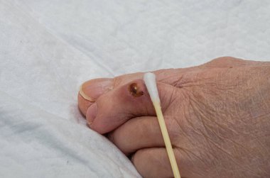 The doctor treats a purulent wound on the leg of an elderly patient with a healing ointment
