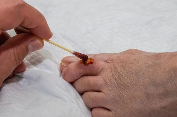 Doctor Treats Purulent Wound Leg Elderly Patient Healing Ointment — Stok fotoğraf