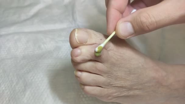 Doctor Treats Purulent Wound Leg Elderly Patient Healing Ointment — Video