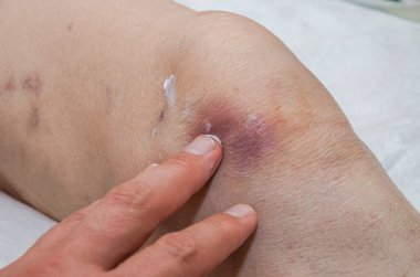 Bir doktor travmatolog, yaşlı bir hastada iyileşen bir merhemle dizinin yakınındaki yaralı bir bacağı tedavi eder.