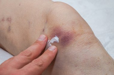 Bir doktor travmatolog, yaşlı bir hastada iyileşen bir merhemle dizinin yakınındaki yaralı bir bacağı tedavi eder.