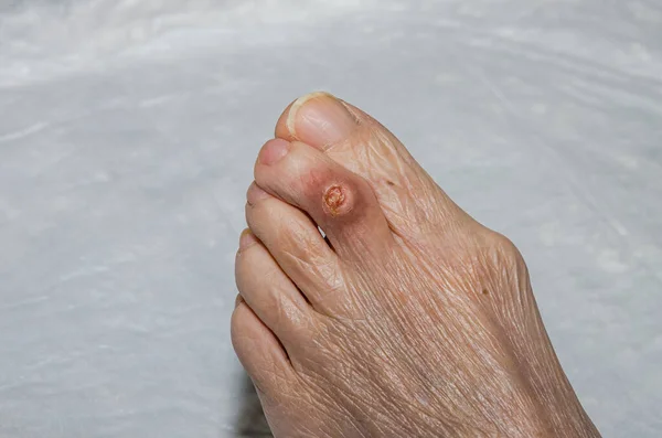 Πληγή Στο Δάχτυλο Ηλικιωμένης Γυναίκας — Φωτογραφία Αρχείου
