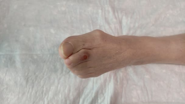 Doctor Treats Purulent Wound Leg Elderly Patient Healing Ointment — Video Stock