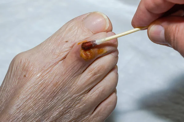 Doctor Treats Purulent Wound Leg Elderly Patient Healing Ointment — Photo
