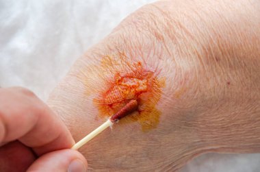 The doctor treats the wound on the arm of an elderly man with iodine