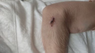 The doctor treats the wound on the arm of an elderly man with iodine