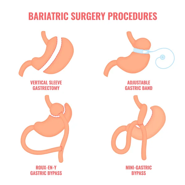 Bariatrische chirurgie gewichtsverlies procedures medische infographics — Stockvector