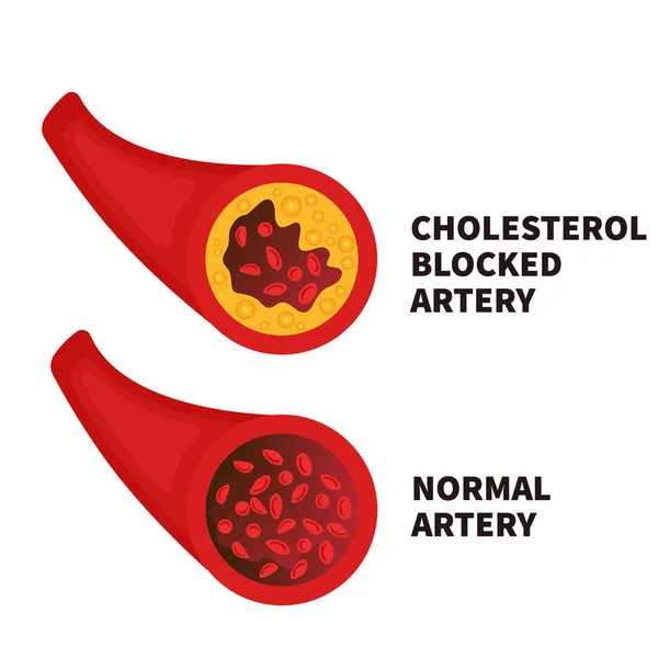 Normale en vernauwde arteriële doorsnede illustratie — Stockvector