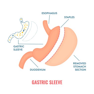 Gastrik kollu bariatrik cerrahi kilo kaybı bilgileri