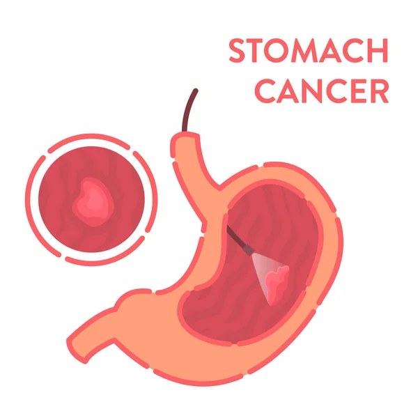 Cancro do estômago detectado por procedimento médico endoscópico —  Vetores de Stock
