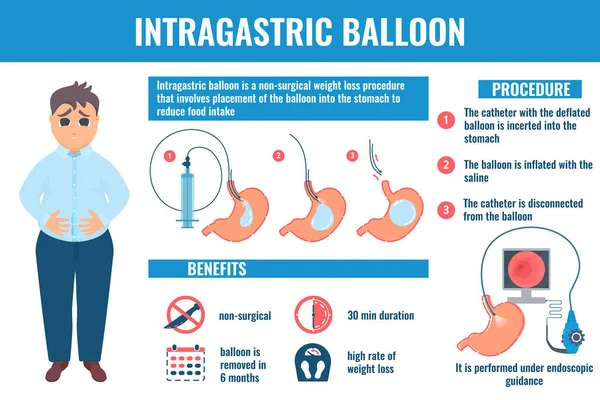 Intragastrische ballon gewichtsverlies procedure medische infographic — Stockvector