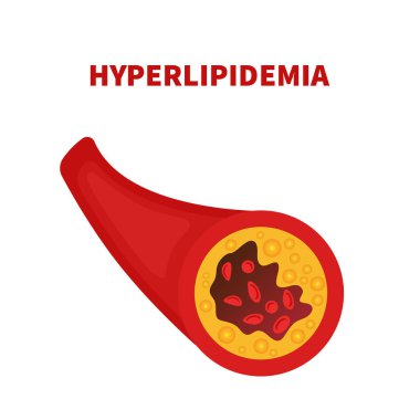 Hyperlipidemia of artery vessel blocked with a clot  clipart