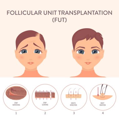 FUT saç nakli prosedürü Tıbbi bilgi iletimi posteri