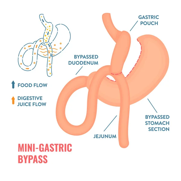 Mini bypass gástrico cirugía bariátrica infografías de pérdida de peso — Archivo Imágenes Vectoriales