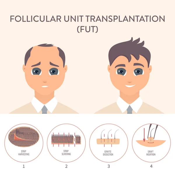 FUT μεταμόσχευση μαλλιών διαδικασία ιατρική infographic αφίσα — Διανυσματικό Αρχείο
