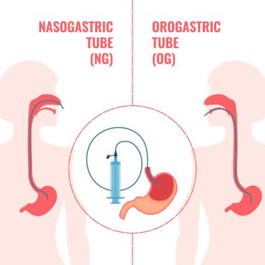 Nasogastrik ve orogastrik beslenme tüpleri tıbbi diyagramı.