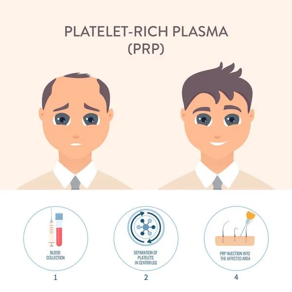 PRP hair loss treatment procedure medical poster — Stock Vector