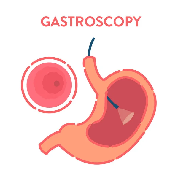 Zabieg gastroskopii badania żołądka — Wektor stockowy