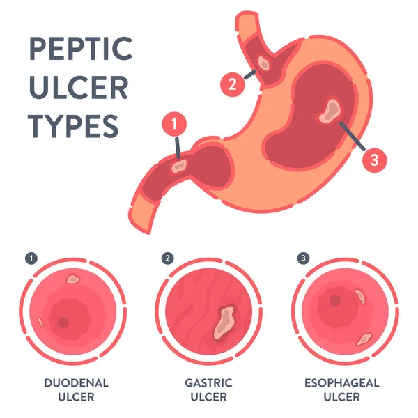 Arten von Magengeschwüren Infografiken — Stockvektor