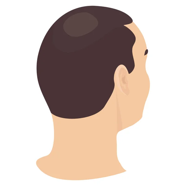 Cabeza Hombre Con Pérdida Cabello Vista Lateral Diferentes Etapas Alopecia — Vector de stock