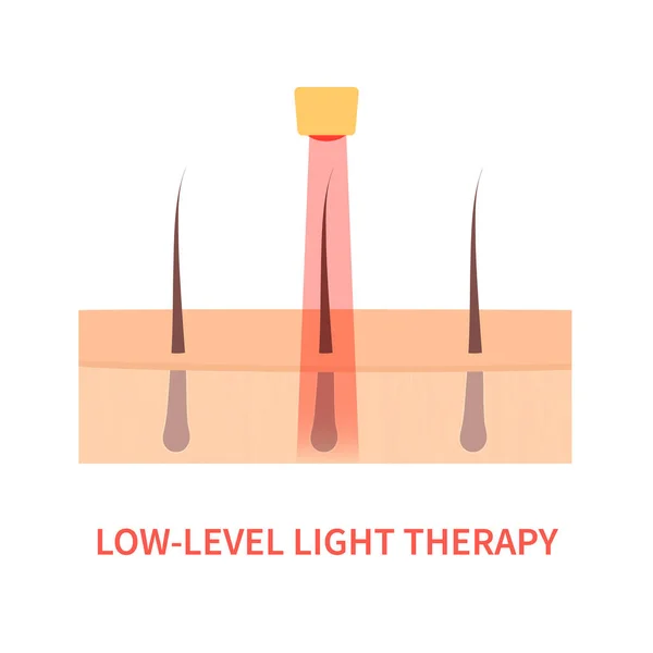 Laser tratamento de terapia de luz vermelha de alopecia — Vetor de Stock