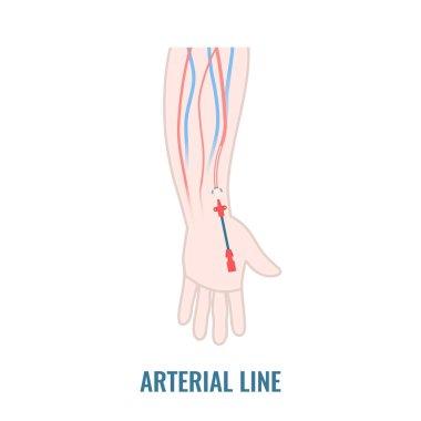 Radyal arterde kateter var.