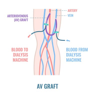 Arteriovenöz diyaliz şant grefti sondası kolda.