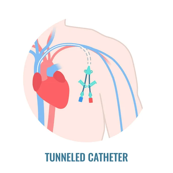 Tuneled central line venous catheter close up — Stockový vektor