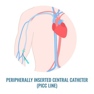 Peripherally inserted central catheter PICC line close up clipart