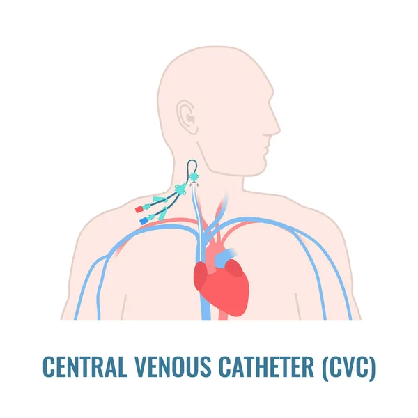 Cateter venoso central jugular interno de perto — Vetor de Stock