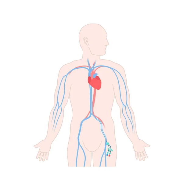 Catéter venoso de línea central femoral en el cuerpo masculino — Vector de stock