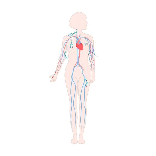女性身体中央静脉导管类型 — 图库矢量图片