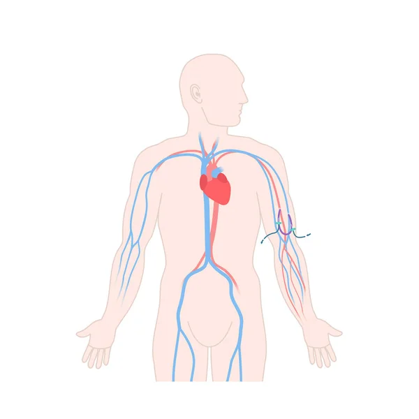 Arteriovenous dialysis shunt graft catheter in male arm — Stockvektor