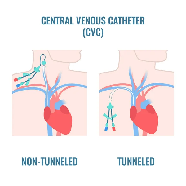 Tipos de cateter venoso de linha central no corpo masculino — Vetor de Stock