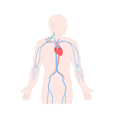 Central venous catheter in the jugular vein