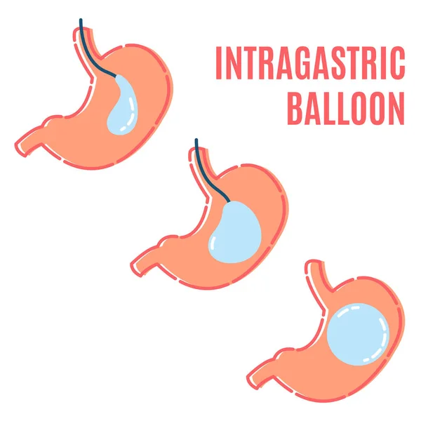 胃の中に胃バルーン非外科的減量手順 熱心な気球配置インフォグラフィックポスター 医療と医療の概念 平型ベクトルイラスト — ストックベクタ