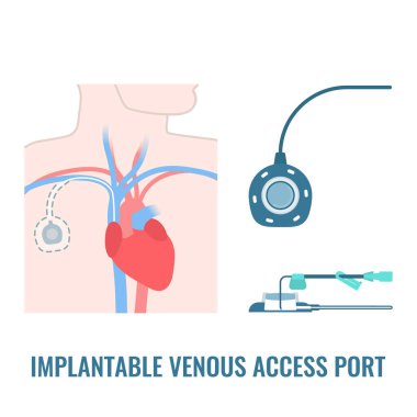 Implantable venous access port. Under the skin central line access device for chemotherapy infusion, medication administration and blood drawing. Medical vector illustration. clipart